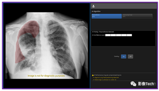 GE医疗气胸AI算法获批FDA！准确率高达100%