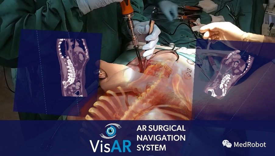 脊柱手术增强现实导航系统获批FDA！