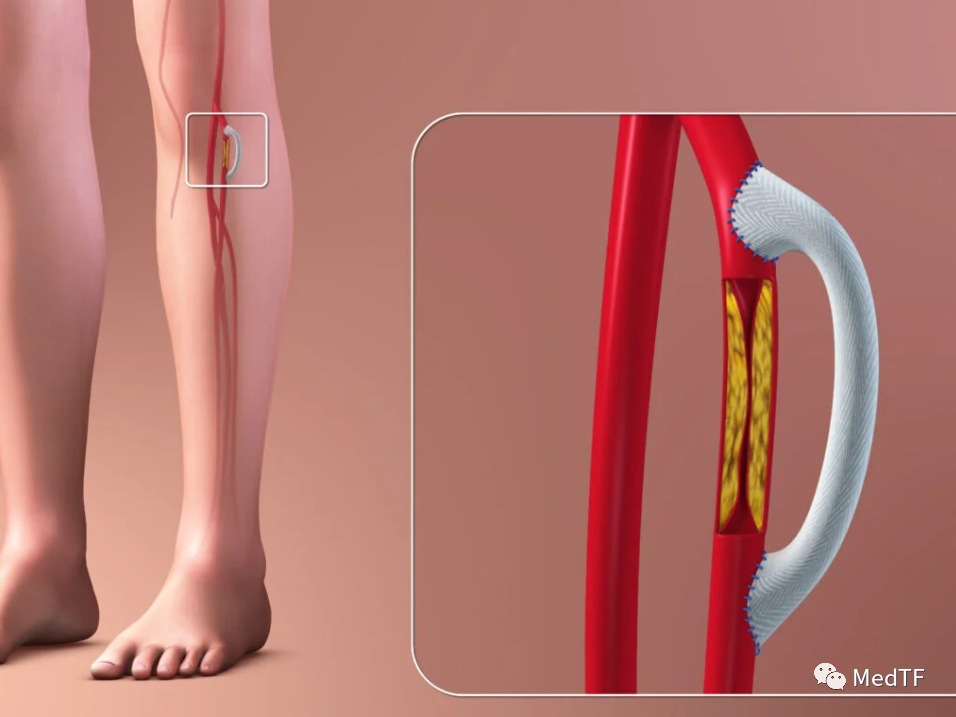 DETOUR：经皮股腘动脉旁路支架正式提交PMA