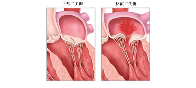 对标雅培，国产二尖瓣独角兽冲刺科创板