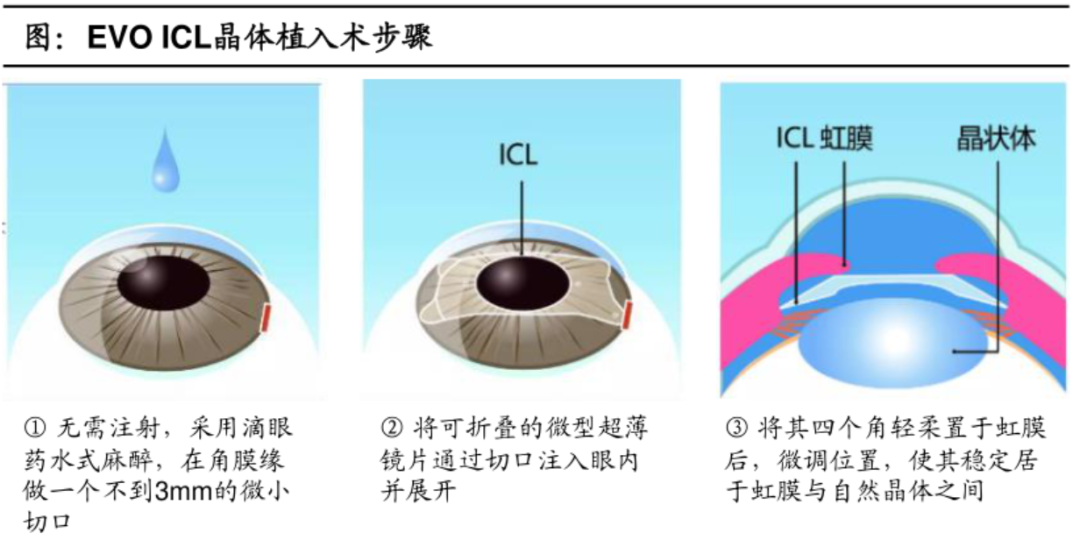 眼科赛道里的微创，几大前沿布局惊现：掘金进口垄断市场，天花板至少增长3倍！