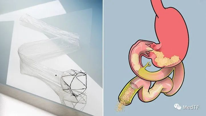 EndoBarrier：最新研究显示治疗Ⅱ型糖尿病和肥胖的患者效果积极