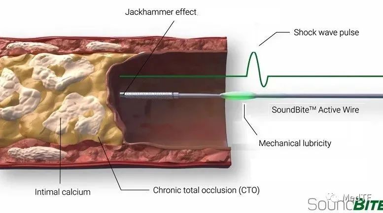 SoundBite：中国企业获得“血管冲击波导丝”大中华权益