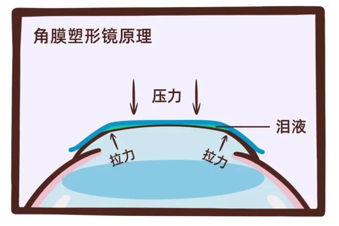 OK镜，作为近视防治最优选，能否进入集采阵营？