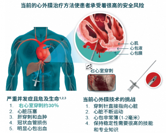 前沿技术：无针头的安全心外膜穿刺技术