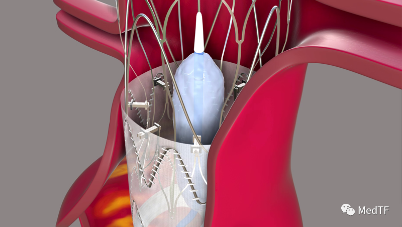 Aortoseal ：具有缝合功能的EVAR覆膜支架