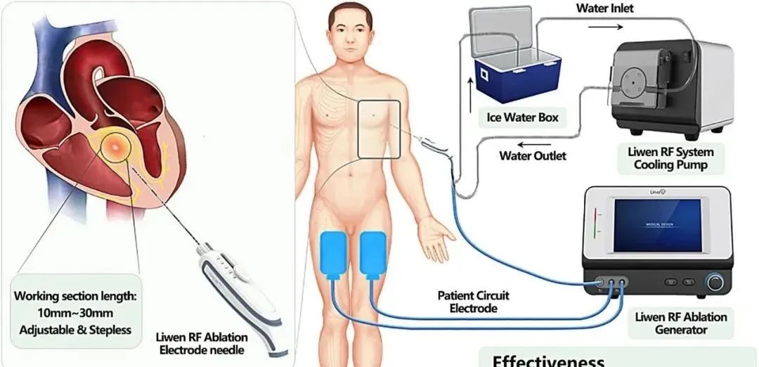 Liwen：肥厚型心肌病射频疗法完成注册临床入组