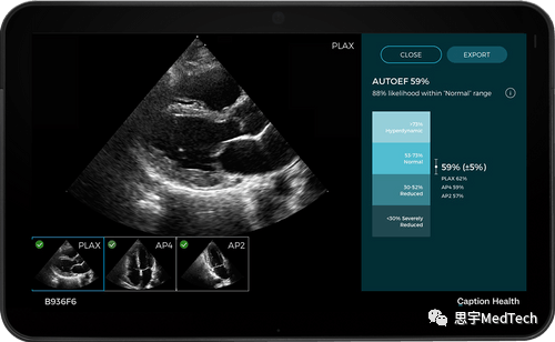 人工智能驱动的心脏超声技术获CE认证