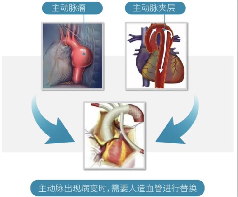 重磅 | 首个国产“人工血管”获NMPA批准上市！