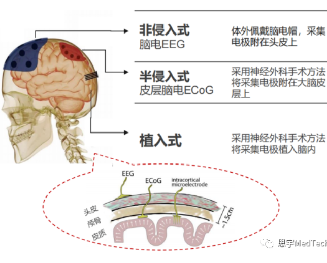 风口之下，脑机接口真正的机会在哪？