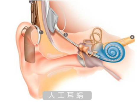 重返“有声世界”，潜力巨大的人工耳蜗市场正在被撬动