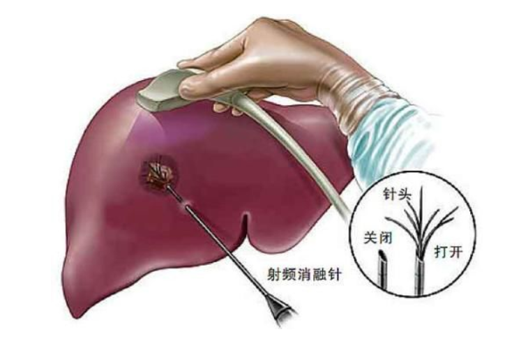 射频消融 VS 冷冻消融 VS 脉冲消融，强生、美敦力、波科布局电生理各有侧重