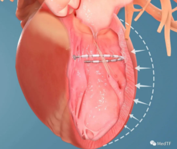 AccuCinch：首款经皮修复心室治疗心衰器械获FDA授予“突破性设备”称号